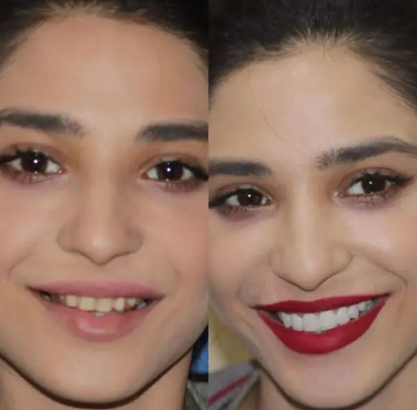 Ramsha Khan Transformation: Before and After Fixing her Teeth!
